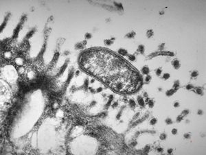 M,82y. | Helicobacter pylori - stomach M,82y. | Helicobacter pylori - stomach